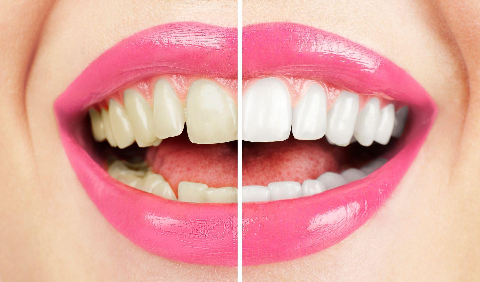 Blanchiment des dents